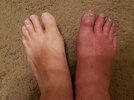 Right Foot 3 Oct 2024 following 2 Oct ant bite.jpg